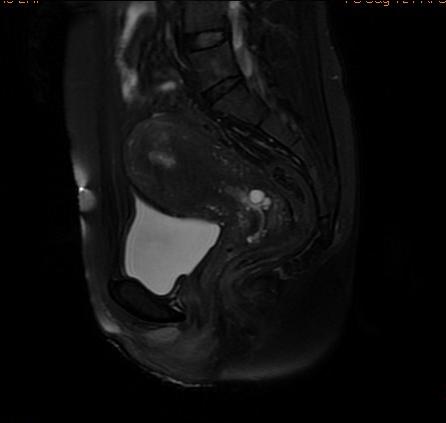 【病例】子宫内膜癌1例MR影像表现 【病例】子宫内膜癌1例MR影像表现