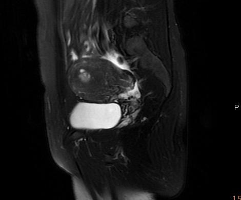 【病例】子宫内膜癌1例MR影像表现 【病例】子宫内膜癌1例MR影像表现
