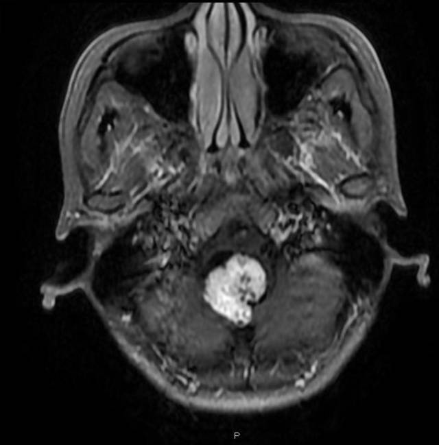 【病例】脑干血管母细胞瘤1例MR影像表现 【病例】脑干血管母细胞瘤1例MR影像表现