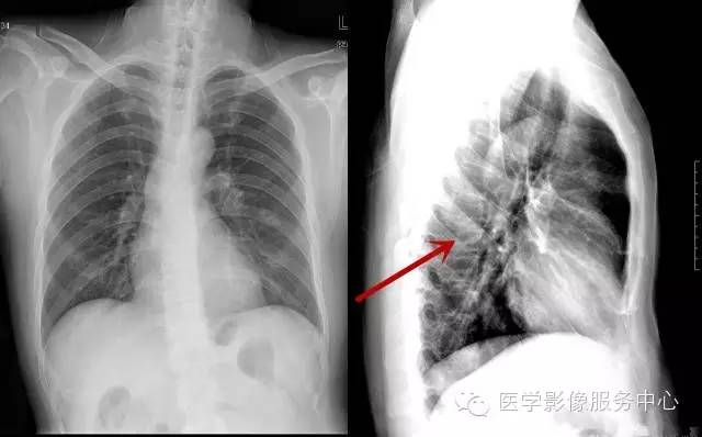 【病例】胸椎骨巨细胞瘤1例MR影像表现