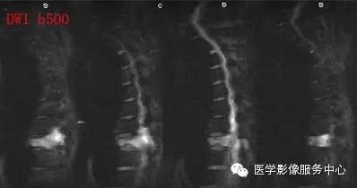 【病例】胸椎骨巨细胞瘤1例MR影像表现 【病例】胸椎骨巨细胞瘤1例MR影像表现