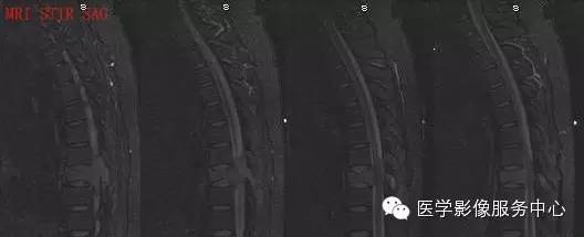 【病例】胸椎骨巨细胞瘤1例MR影像表现 【病例】胸椎骨巨细胞瘤1例MR影像表现