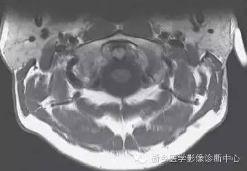颈椎精细解剖+详细标注
