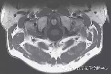颈椎精细解剖+详细标注