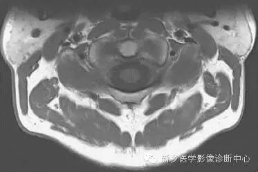 颈椎精细解剖+详细标注