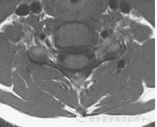 颈椎精细解剖+详细标注