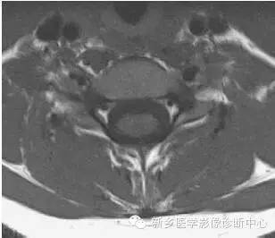 颈椎精细解剖+详细标注