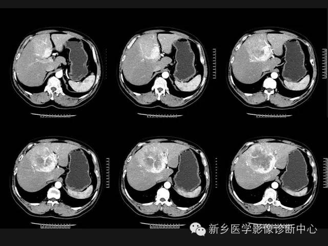 【病例】肝脏胃肠道间质瘤转移1例CT影像表现