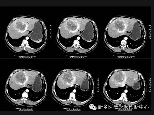 【病例】肝脏胃肠道间质瘤转移1例CT影像表现