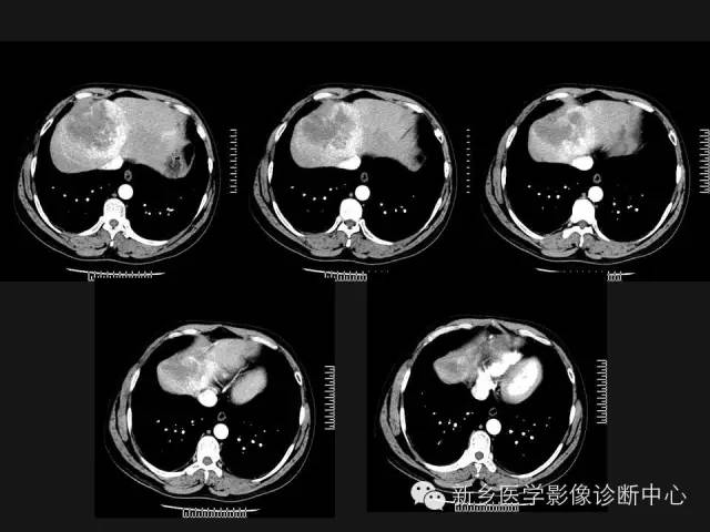 【病例】肝脏胃肠道间质瘤转移1例CT影像表现