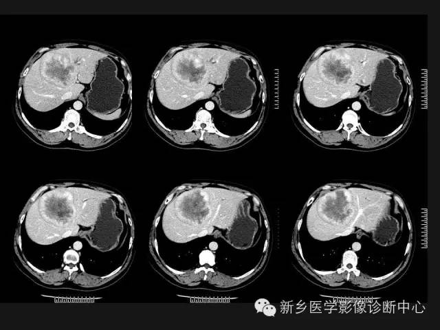 【病例】肝脏胃肠道间质瘤转移1例CT影像表现