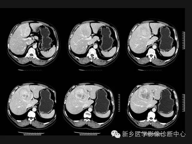 【病例】肝脏胃肠道间质瘤转移1例CT影像表现