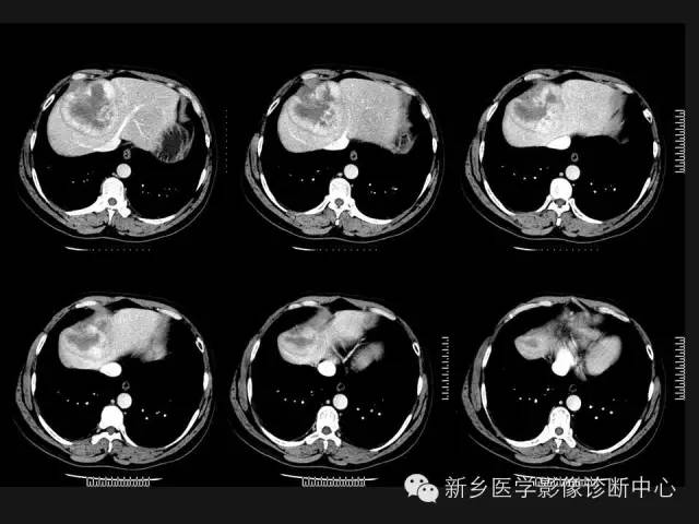 【病例】肝脏胃肠道间质瘤转移1例CT影像表现