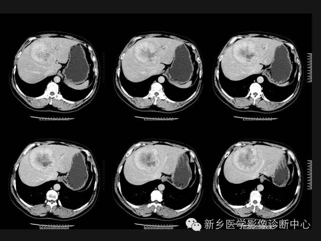 【病例】肝脏胃肠道间质瘤转移1例CT影像表现