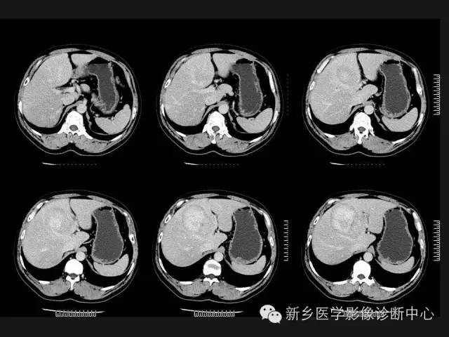 【病例】肝脏胃肠道间质瘤转移1例CT影像表现