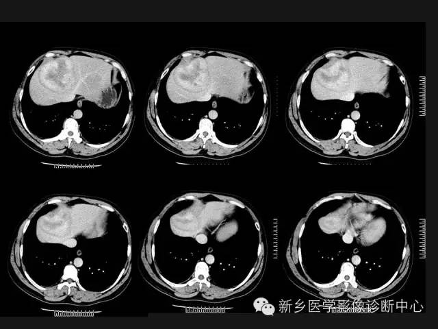 【病例】肝脏胃肠道间质瘤转移1例CT影像表现