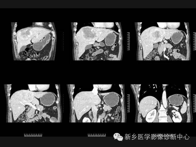【病例】肝脏胃肠道间质瘤转移1例CT影像表现
