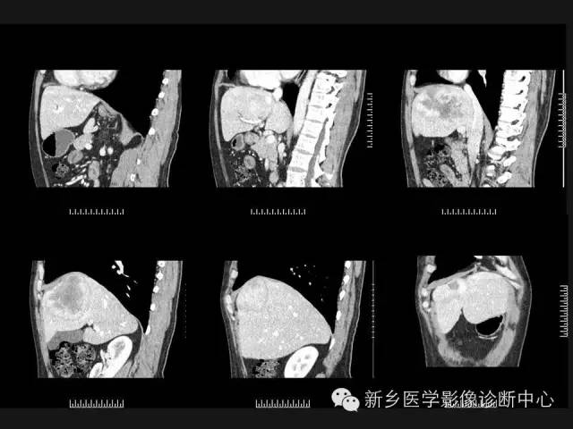 【病例】肝脏胃肠道间质瘤转移1例CT影像表现
