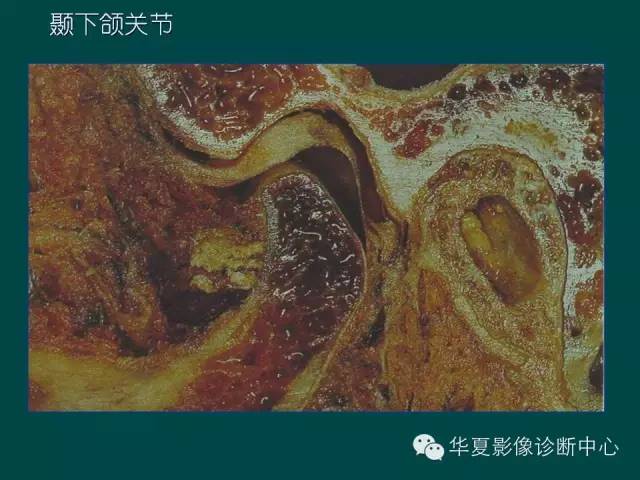 【PPT】颞下颌关节紊乱病