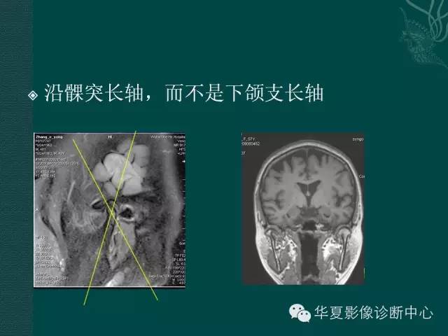 【PPT】颞下颌关节紊乱病