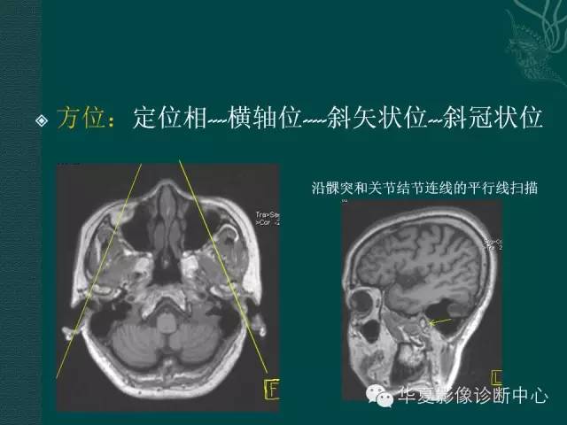【PPT】颞下颌关节紊乱病