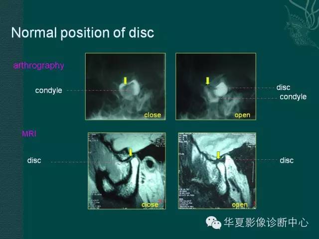 【PPT】颞下颌关节紊乱病