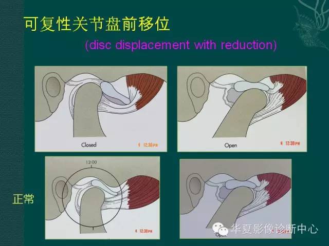 【PPT】颞下颌关节紊乱病