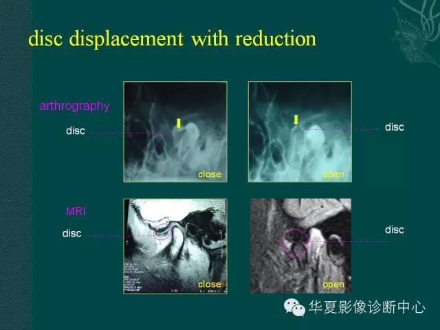 【PPT】颞下颌关节紊乱病
