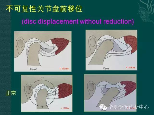 【PPT】颞下颌关节紊乱病