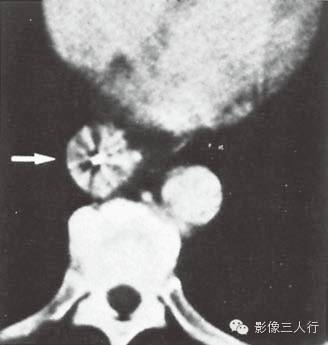 奇静脉食管隐窝异常的CT表现 奇静脉食管隐窝异常的CT表现