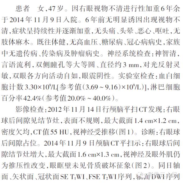 【病例】右眼眶内异位涎腺组织一例影像表现 【病例】右眼眶内异位涎腺组织一例影像表现