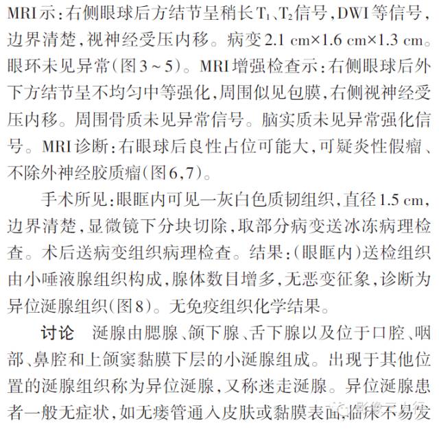 【病例】右眼眶内异位涎腺组织一例影像表现 【病例】右眼眶内异位涎腺组织一例影像表现