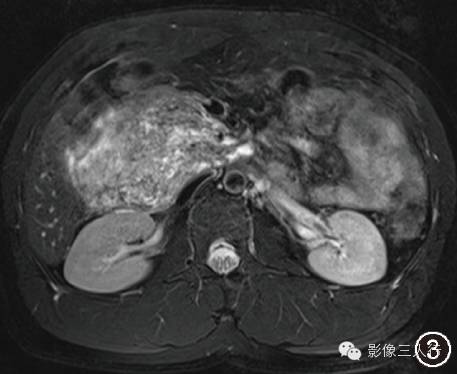 【病例】胰头巨大血管淋巴管瘤一例影像表现