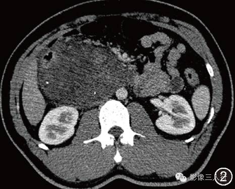【病例】胰头巨大血管淋巴管瘤一例影像表现 【病例】胰头巨大血管淋巴管瘤一例影像表现