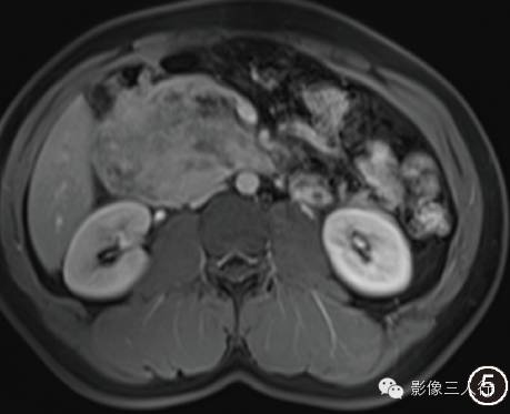 【病例】胰头巨大血管淋巴管瘤一例影像表现 【病例】胰头巨大血管淋巴管瘤一例影像表现