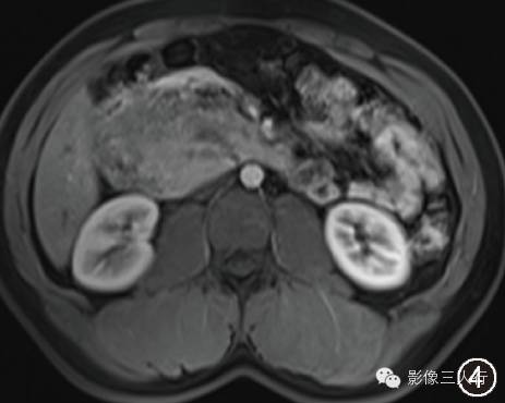 【病例】胰头巨大血管淋巴管瘤一例影像表现 【病例】胰头巨大血管淋巴管瘤一例影像表现