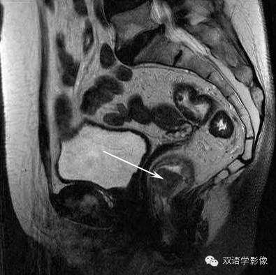 【双语病例】直肠癌1例