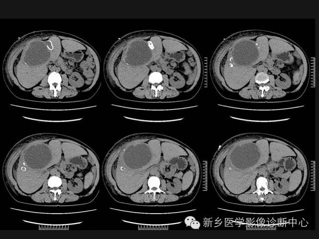 【病例】肝脏粘液性囊性肿瘤1例CT影像表现