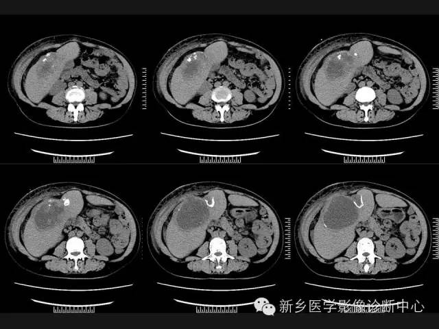【病例】肝脏粘液性囊性肿瘤1例CT影像表现
