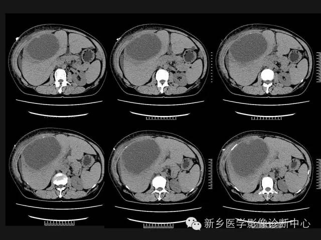 【病例】肝脏粘液性囊性肿瘤1例CT影像表现