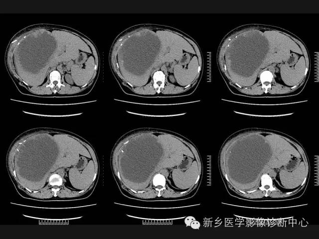 【病例】肝脏粘液性囊性肿瘤1例CT影像表现
