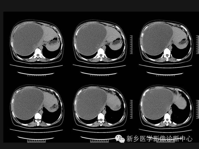 【病例】肝脏粘液性囊性肿瘤1例CT影像表现