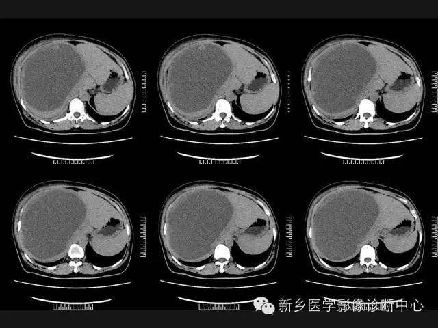 【病例】肝脏粘液性囊性肿瘤1例CT影像表现