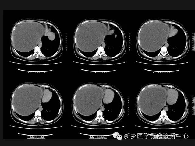 【病例】肝脏粘液性囊性肿瘤1例CT影像表现