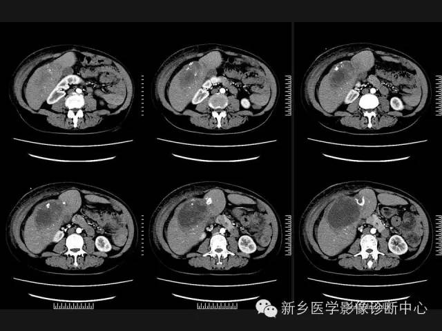 【病例】肝脏粘液性囊性肿瘤1例CT影像表现