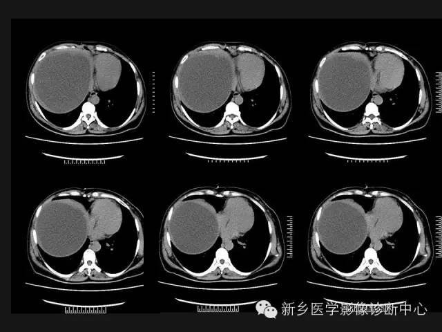 【病例】肝脏粘液性囊性肿瘤1例CT影像表现