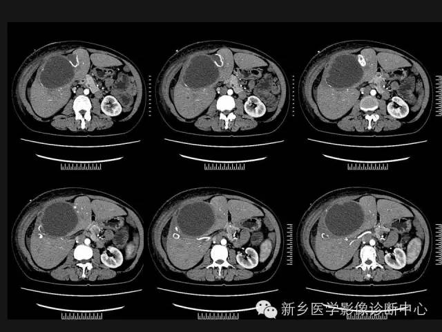 【病例】肝脏粘液性囊性肿瘤1例CT影像表现