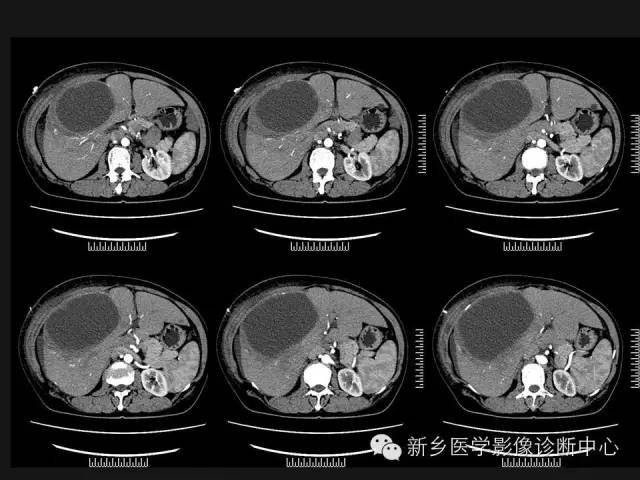 【病例】肝脏粘液性囊性肿瘤1例CT影像表现