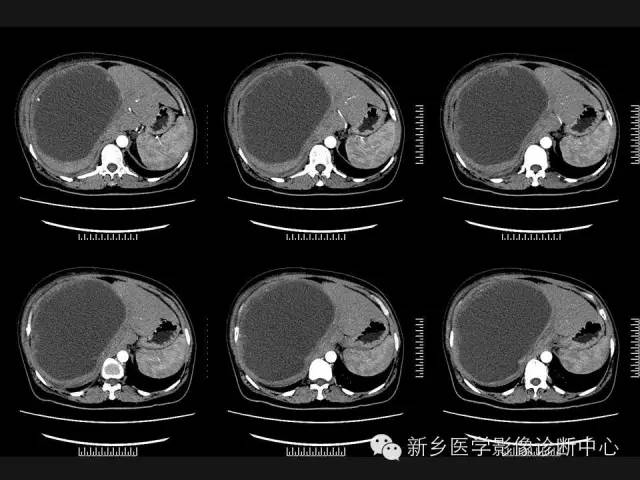 【病例】肝脏粘液性囊性肿瘤1例CT影像表现