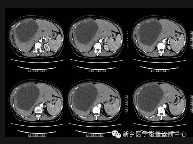 【病例】肝脏粘液性囊性肿瘤1例CT影像表现